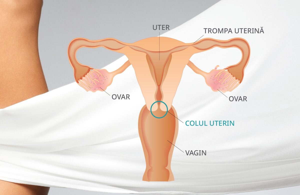 Cancerul de col uterin poate fi prevenit! Ce este cancerul de col uterin?