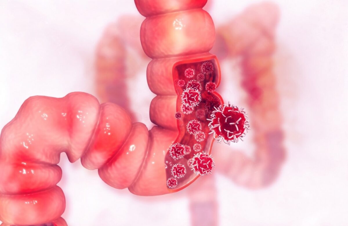 Descoperire în cancerul colorectal, anunțată de australieni